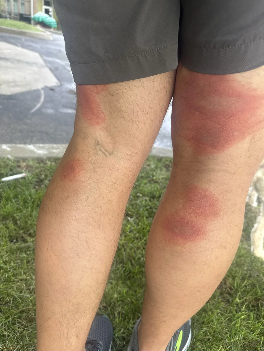 back of leg rash